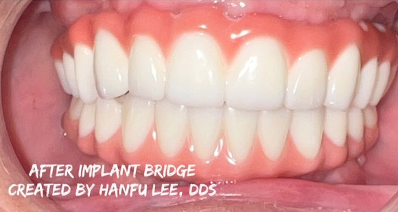 After implant procedure at the practice of Dr. Hanfu Lee in Arcadia, CA