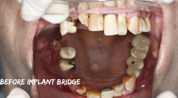 Before implant procedure at the practice of Dr. Hanfu Lee in Arcadia, CA