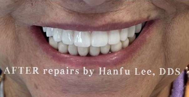 After implant procedure at the practice of Dr. Hanfu Lee in Arcadia, CA