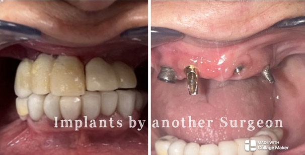 Before and after implant procedure at the practice of Dr. Hanfu Lee in Arcadia, CA