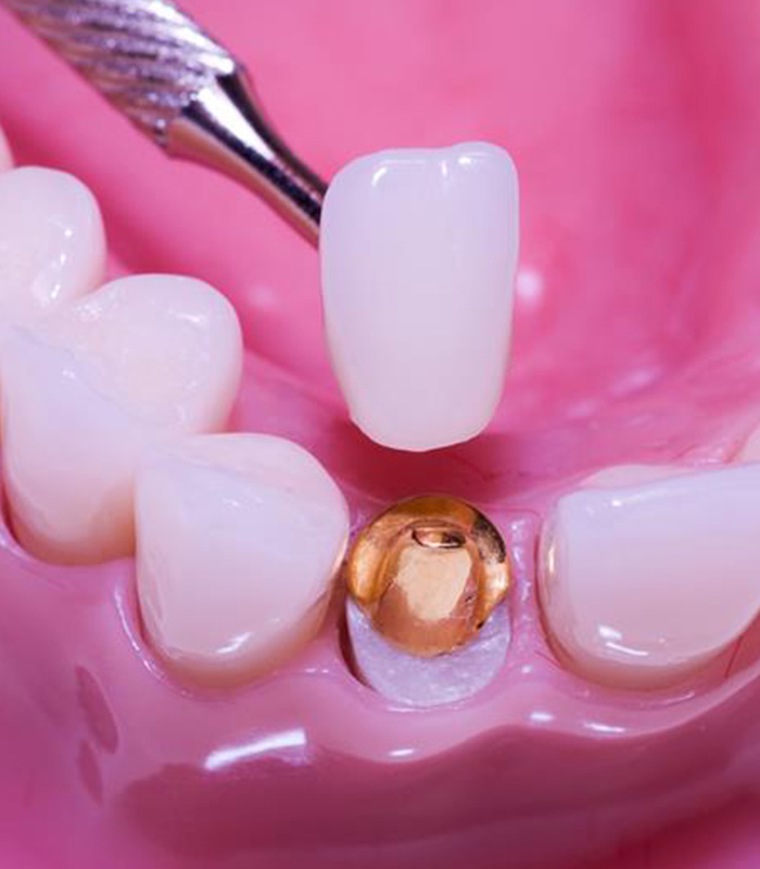 Porcelain Crowns