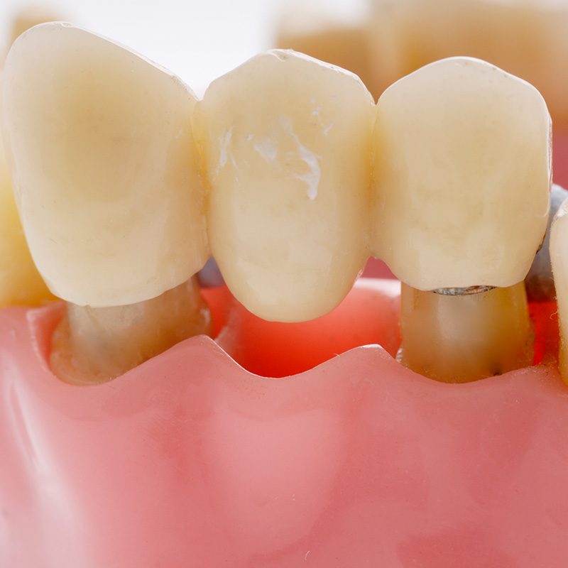 Model of dental bridge used to replace missing tooth