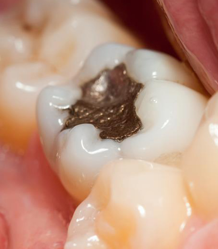 Dental fillings